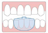 NTI-tss-Plus